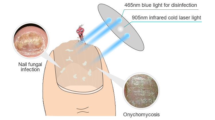 dispositivo laser para tratamento de fungos nas unhas