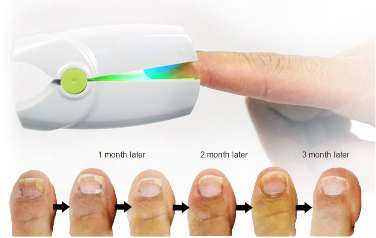 laser device for nails