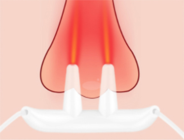 Acute Rhinitis Ease Lighting Apparatus