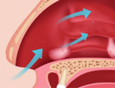 nasal laser therapy device