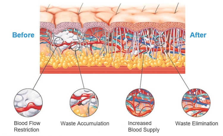 shock wave therapy