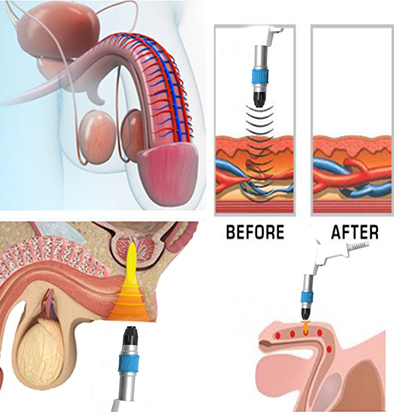 shock wave therapy machine