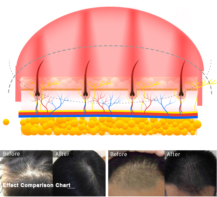 hair growth machine