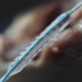 VesSpiral® 旋刻®螺纹球囊扩张导管