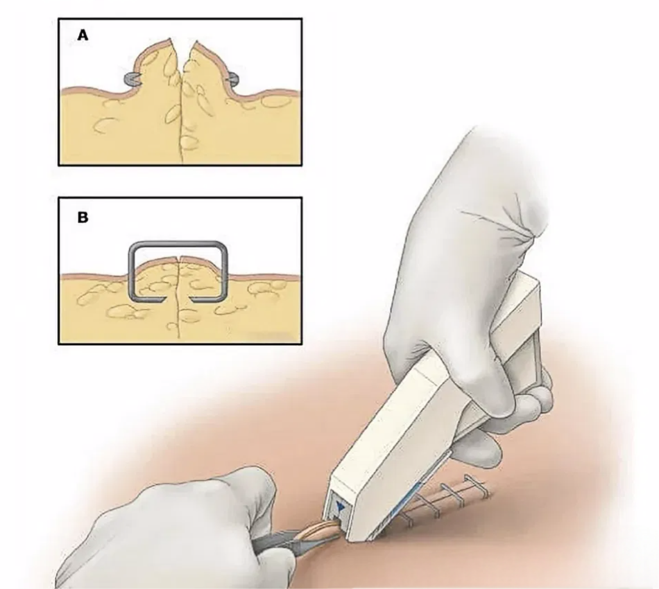 Skin Suture Stapler