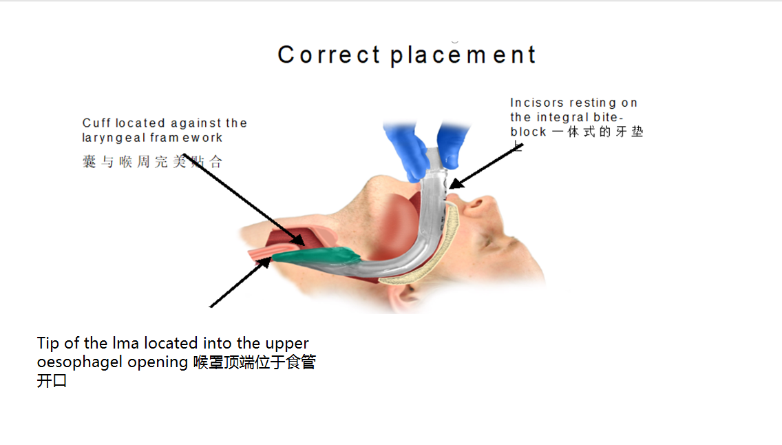 Easy Laryngeal Mask