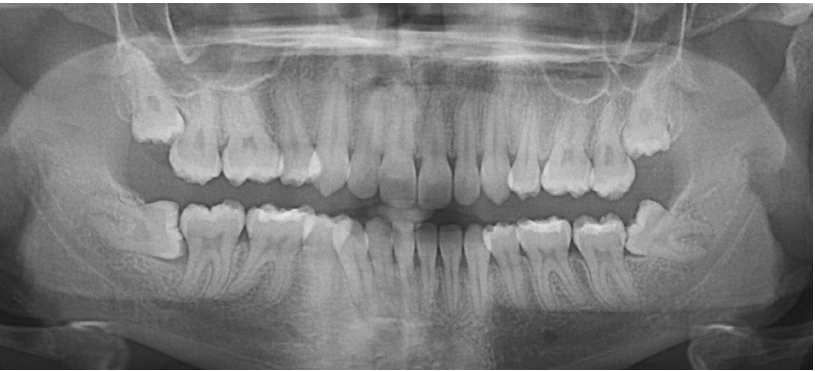 X-ray dental fiber optic plate X-ray dental fiber optic plate