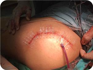 Применение Bi-Fix в ортопедической хирургии
