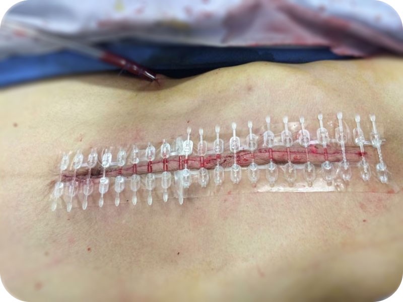 O conjunto de fechamento de incisão Bi-Fix pode ser uma alternativa à sutura na maioria das incisões cirúrgicas gerais.