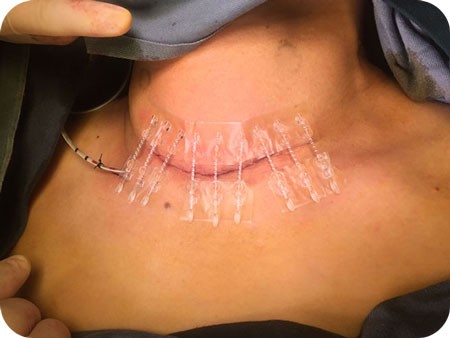 Bi-Fix pode ser aplicado em incisões na cirurgia da cabeça, face e pescoço.