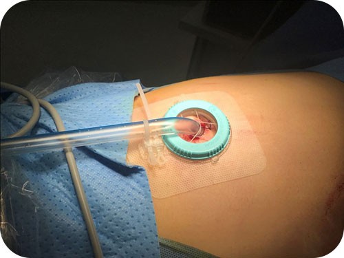 Aplicação de Loopix em cirurgia torácica alternativa à fixação de suturas.