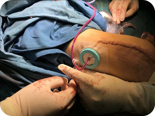 Применение Loopix в хирургии ортопедии