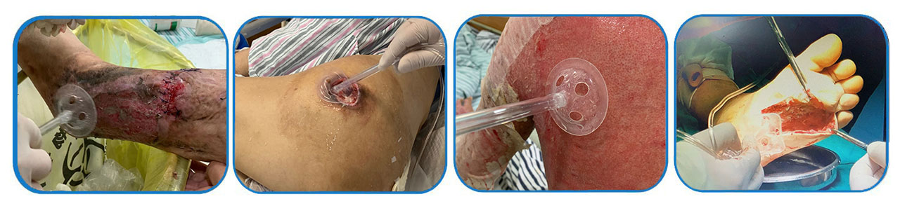 Bi-Fix Non-invasive Surgical Incision Closure Set 