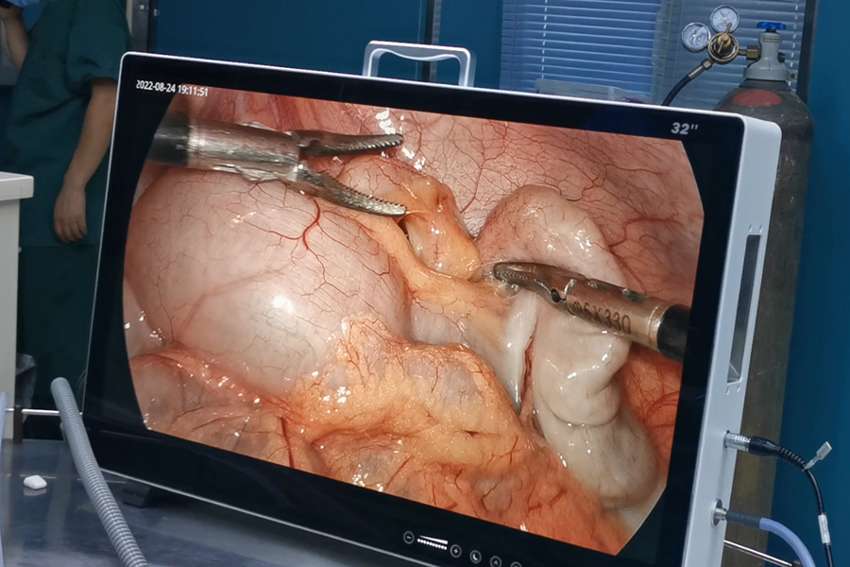 laparoscopic Surgery