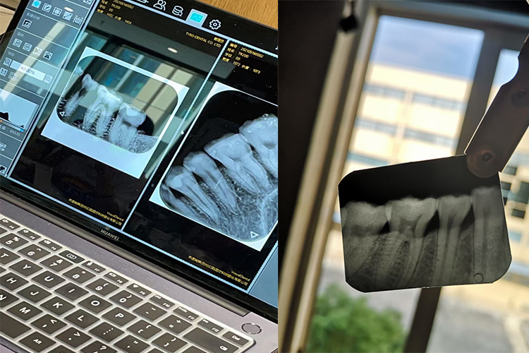 digital dental x ray machine