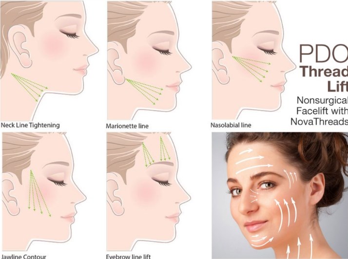 Supply Face Use pdo thread with needle Korea MONO Screw PDO Thread Lift