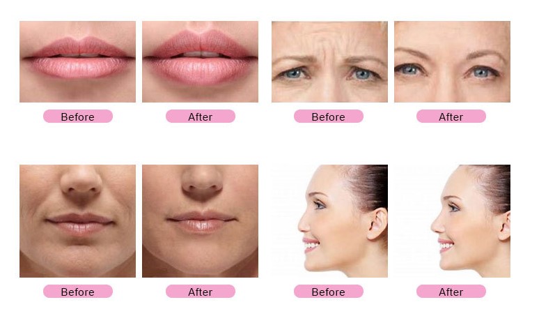 Dermal Filler