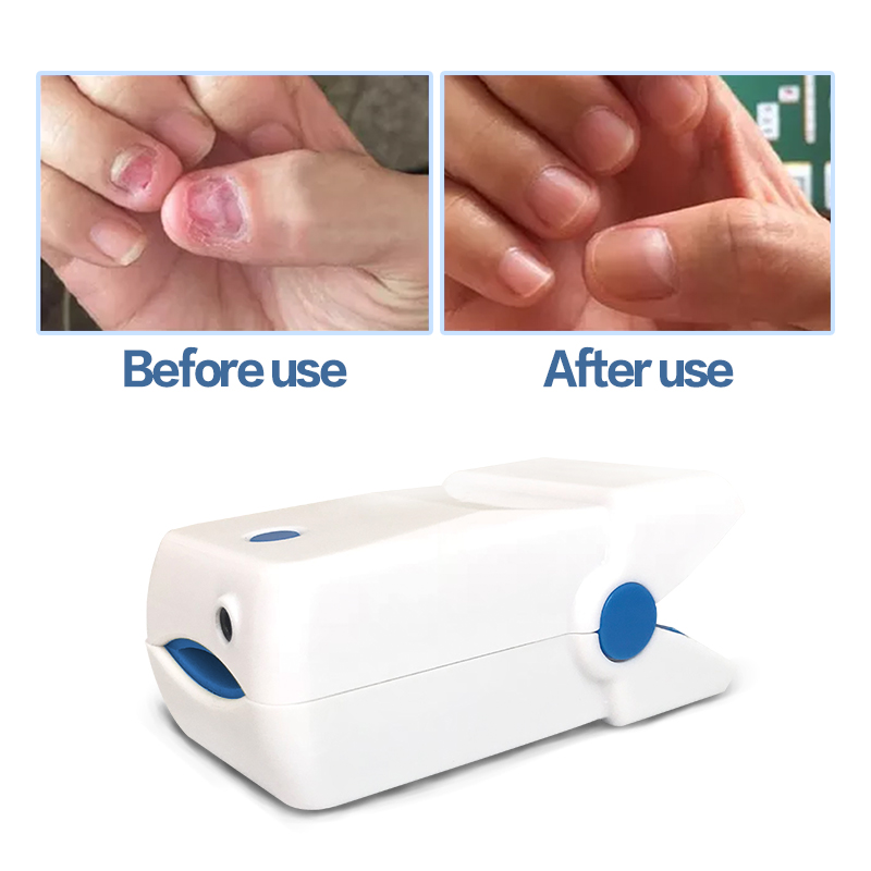 Home Fingernail Fungus Laser Treatment