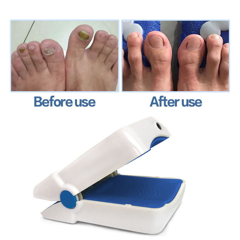 Fungal Nail Laser Therapy For Onychomycosis
