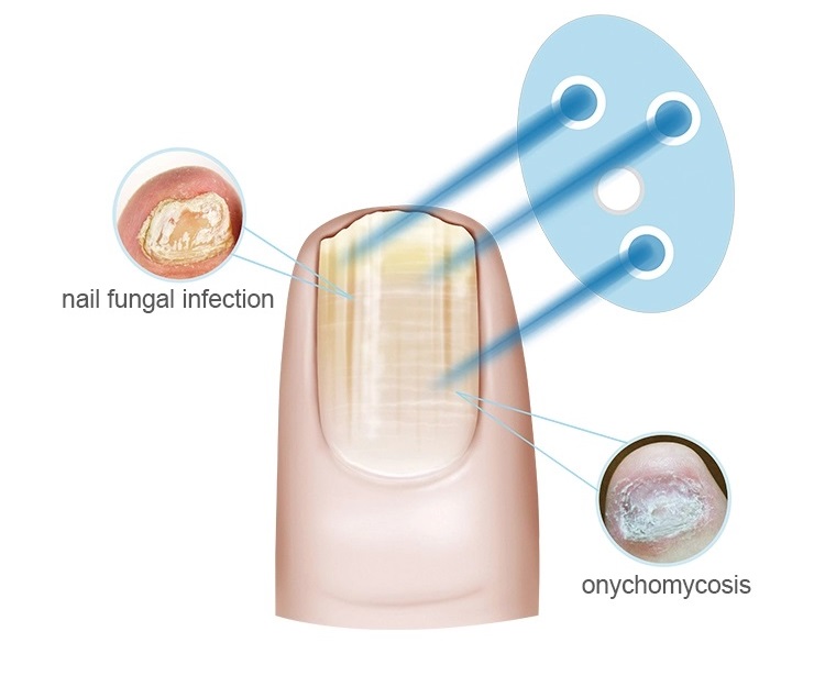 nail cleaning laser device