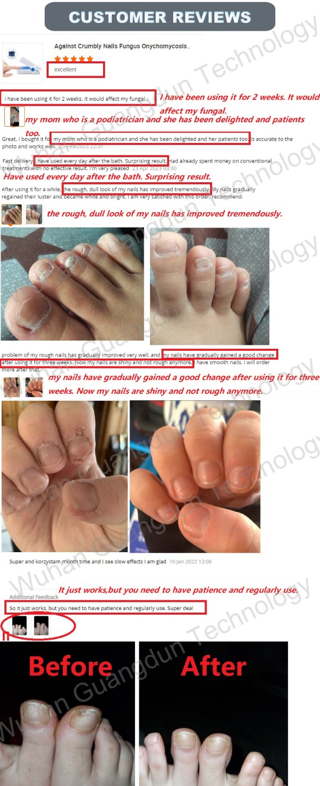 Laser treatment for fungal nail infection