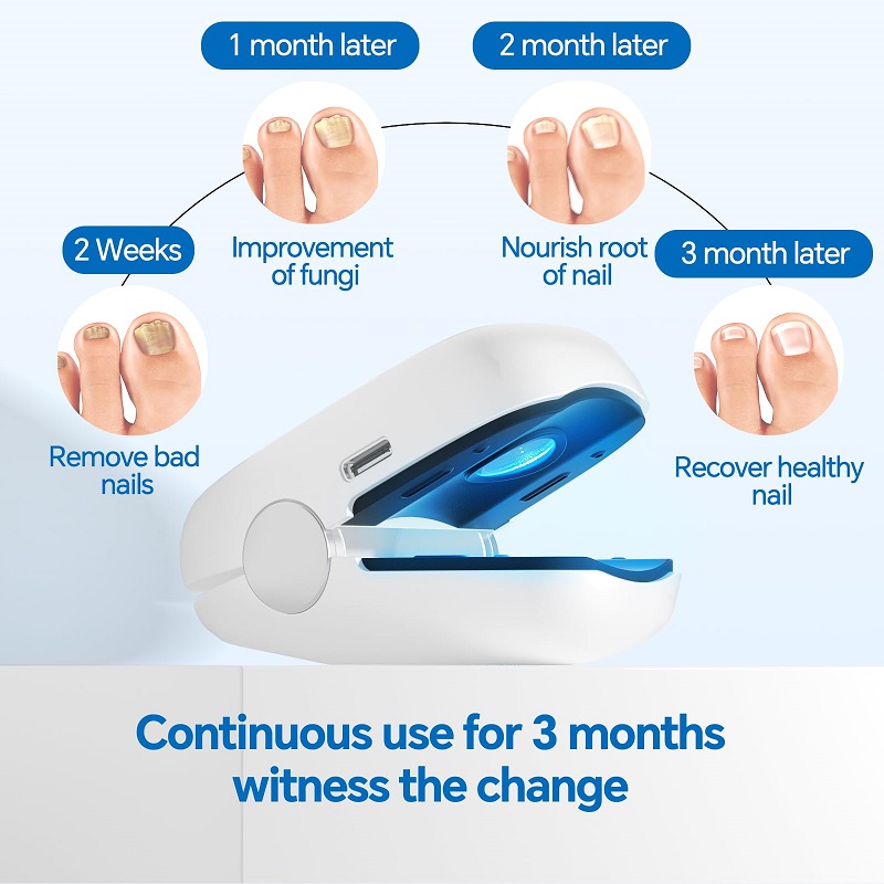 Highly Effective Home Use Nail-fungus Remover for Onychomycosis Nail Treatment Laser Device