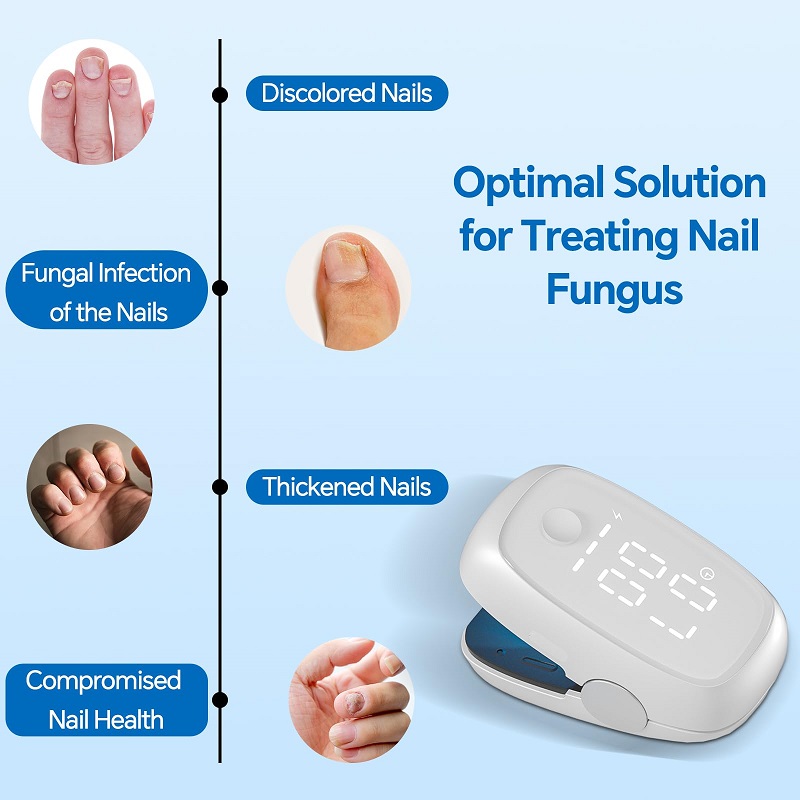 Highly Effective Home Use Nail-fungus Remover for Onychomycosis Nail Treatment Laser Device