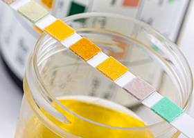 Urine Test Strips