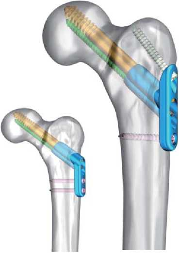 Bone Plates And Nails In Titanium Bone Surgery