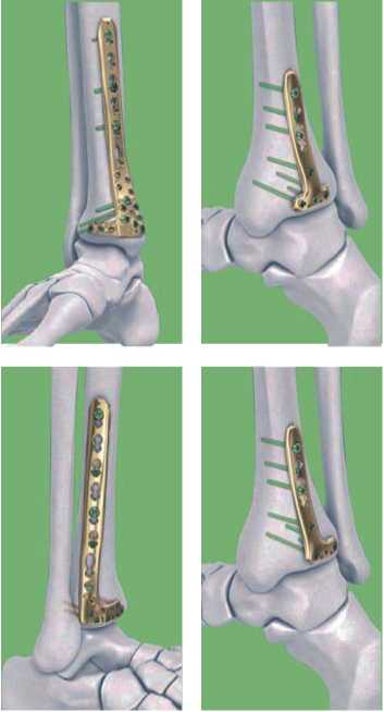 surgical bone plate