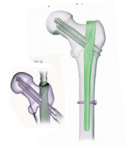 Bone Plates And Nails In Titanium Bone Surgery