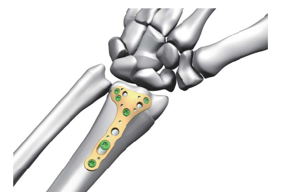 Bone Plates And Nails In Titanium Bone Surgery