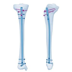 Placas ósseas e pregos em cirurgia óssea de titânio