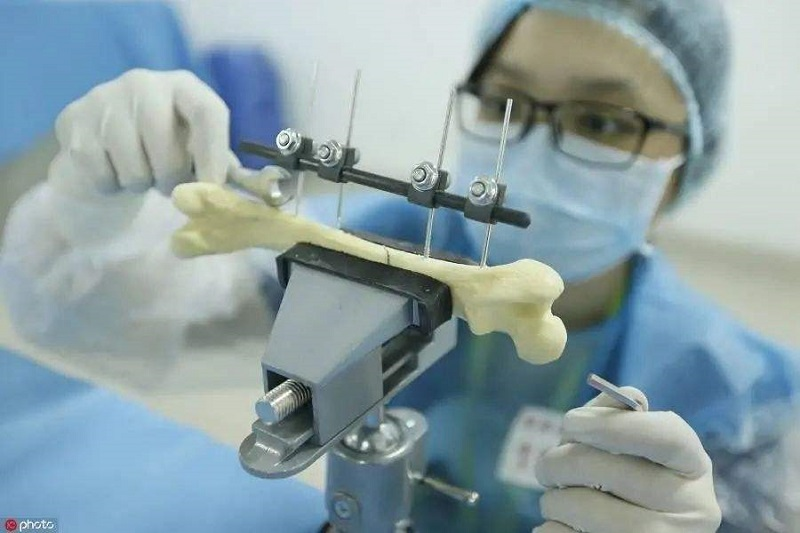 Avancées dans la série de vis pour plaques osseuses médicales
