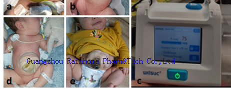 Rainhome NPWT system for Omphalocele