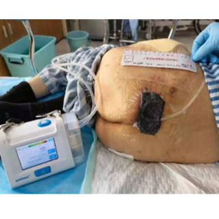 Dispositif NPWT de système de traitement des plaies par pression négative sous vide