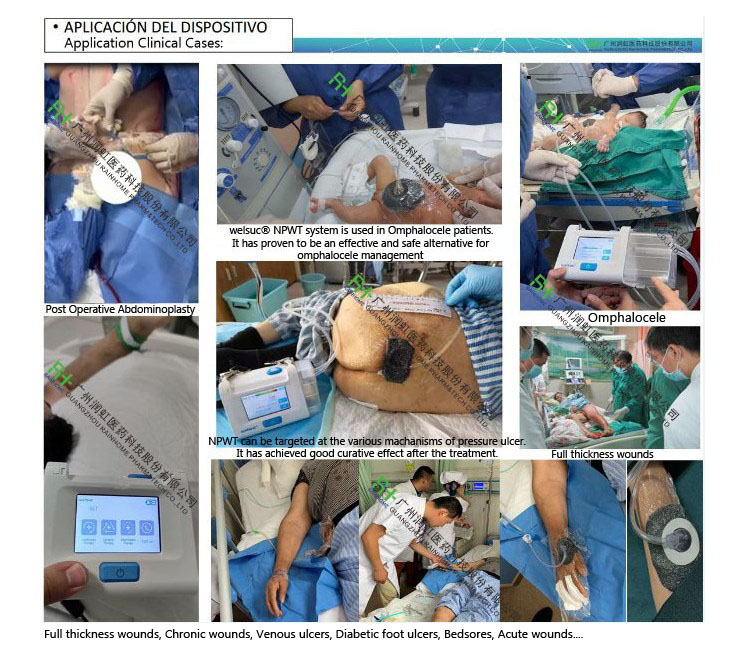 Negative Pressure Wound Theray System