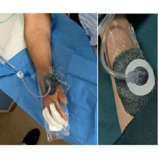 Kit de vendaje para terapia de heridas con presión negativa Espuma negra