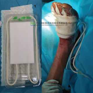 NPWT White PVA Foam Dressing Kit