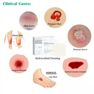 Apósito hidrocoloide para el cuidado de heridas