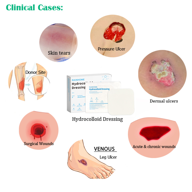 wound care hydrocolloid dressings