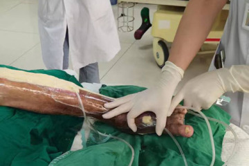 Hệ thống trị liệu vết thương áp lực âm cho bệnh nhân tiểu đường ở chân