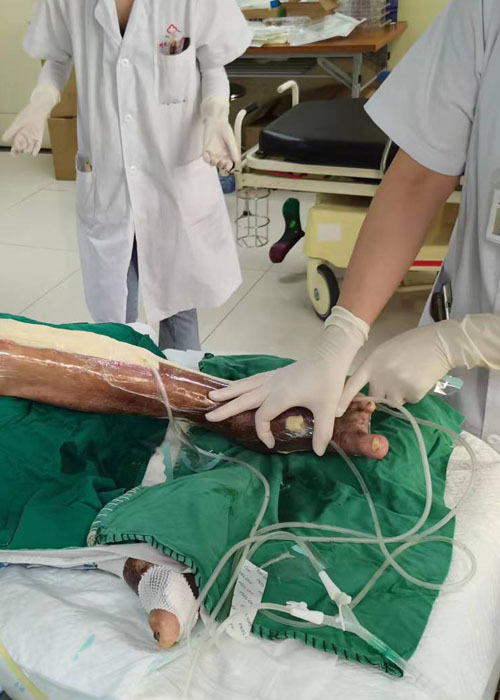 Hệ thống trị liệu vết thương áp lực âm cho bệnh nhân tiểu đường ở chân