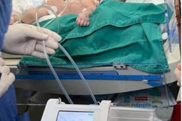 hệ thống trị liệu vết thương áp lực âm cho vết thương
