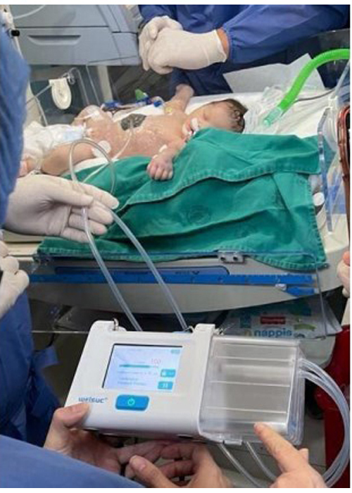 sistem terapi luka tekanan negatif untuk luka