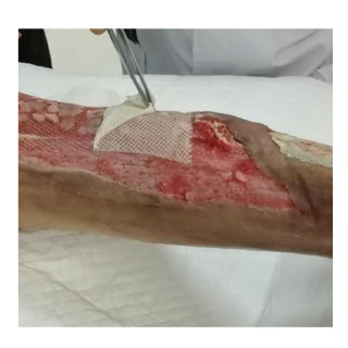 Apósito para el cuidado de heridas de gasa con aceite hidrocoloide