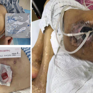 Apósito para el cuidado de heridas de gasa con aceite hidrocoloide
