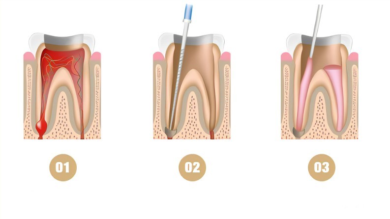 Root Canal Preparation Machine