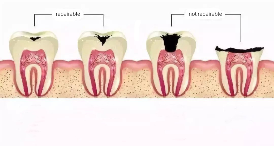 ENDOMOTOR Root canal preparation machine