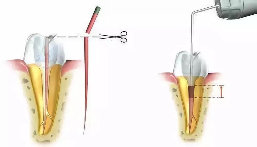 Root Canal Preparation